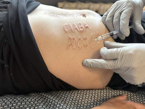 러시아에 포로로 잡혔던 우크라 군인의 배에 새겨진 '러시아에 영광을'.<막심 투르케비치 페이스북 캡처, 연합뉴스>